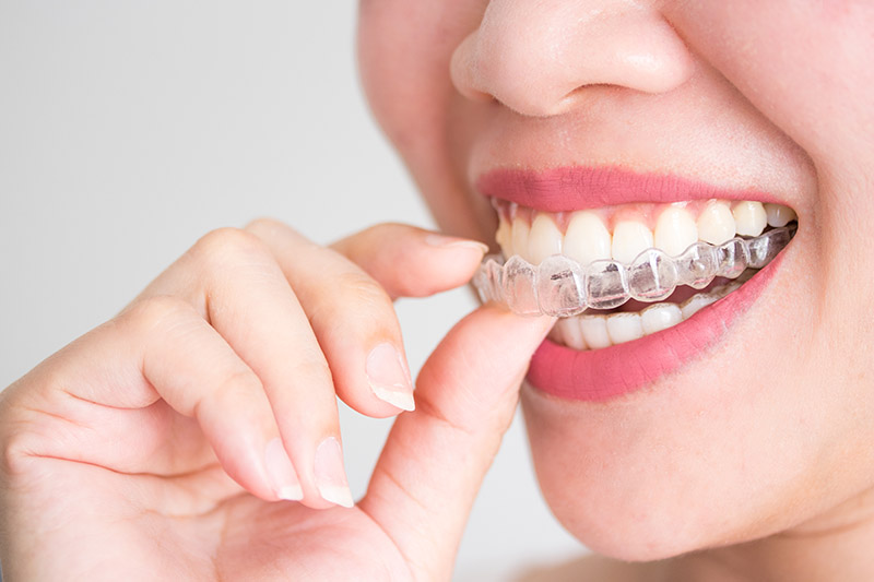 Invisalign in Greensboro