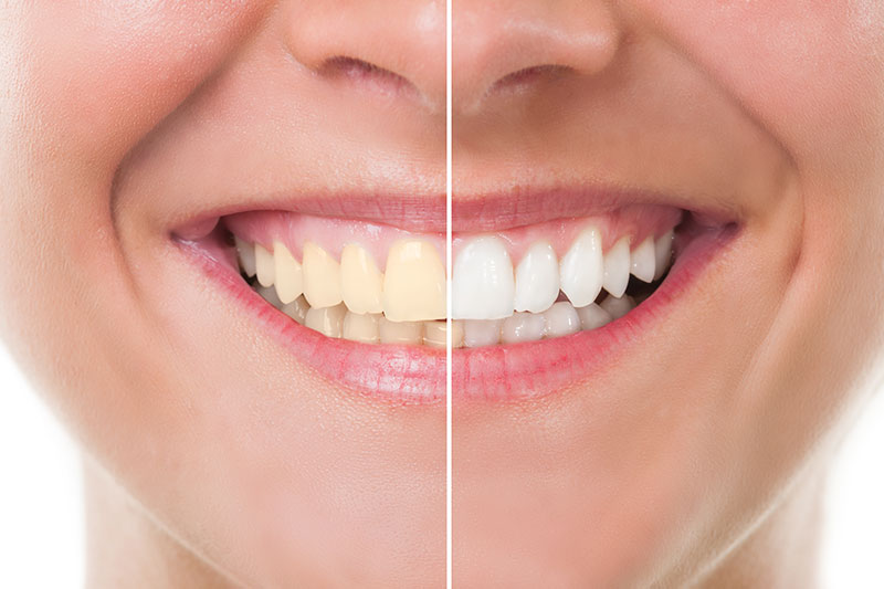 Teeth Whitening in Greensboro